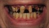decayed%20teeth.jpg
